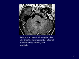 Axial MRI in patient with suppurative
labyrinthitis. Enhancement of internal
auditory canal, cochlea, and
vestibule.



                                         52
 