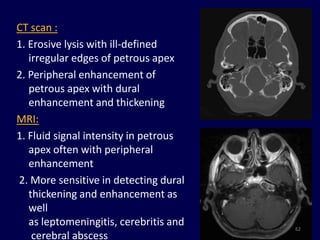 CT scan :
1. Erosive lysis with ill-defined
   irregular edges of petrous apex
2. Peripheral enhancement of
   petrous apex with dural
   enhancement and thickening
MRI:
1. Fluid signal intensity in petrous
   apex often with peripheral
   enhancement
2. More sensitive in detecting dural
   thickening and enhancement as
   well
   as leptomeningitis, cerebritis and   62
    cerebral abscess
 