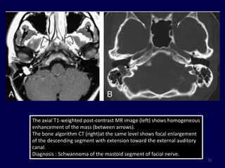 The axial T1-weighted post-contrast MR image (left) shows homogeneous
enhancement of the mass (between arrows).
The bone algorithm CT (right)at the same level shows focal enlargement
of the descending segment with extension toward the external auditory
canal.
Diagnosis : Schwannoma of the mastoid segment of facial nerve.
                                                                         72
 