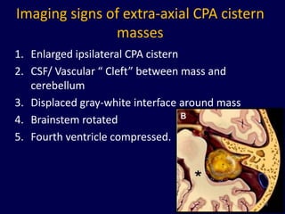 Imaging signs of extra-axial CPA cistern
               masses
1. Enlarged ipsilateral CPA cistern
2. CSF/ Vascular “ Cleft” between mass and
   cerebellum
3. Displaced gray-white interface around mass
4. Brainstem rotated
5. Fourth ventricle compressed.




                                                78
 