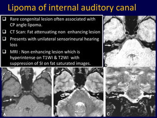 Lipoma of internal auditory canal
 Rare congenital lesion often associated with
  CP angle lipoma.
 CT Scan: Fat attenuating non enhancing lesion
 Presents with unilateral sensorineural hearing
  loss
 MRI : Non enhancing lesion which is
  hyperintense on T1WI & T2WI with
  suppression of SI on fat saturated images.




                                                   87
 