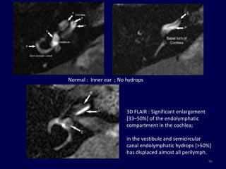 Normal : Inner ear ; No hydrops




                        3D FLAIR : Significant enlargement
                        [33–50%] of the endolymphatic
                        compartment in the cochlea;

                        in the vestibule and semicircular
                        canal endolymphatic hydrops [>50%]
                        has displaced almost all perilymph.
                                                             96
 