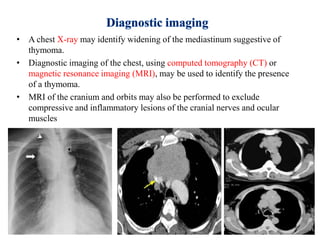 • A chest X-ray may identify widening of the mediastinum suggestive of
thymoma.
• Diagnostic imaging of the chest, using computed tomography (CT) or
magnetic resonance imaging (MRI), may be used to identify the presence
of a thymoma.
• MRI of the cranium and orbits may also be performed to exclude
compressive and inflammatory lesions of the cranial nerves and ocular
muscles
2/19/2017 34MYASTHENIA GRAVIS
 