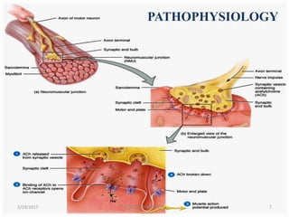 PATHOPHYSIOLOGY
2/19/2017 7MYASTHENIA GRAVIS
 