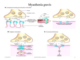 Myasthenia gravis
2/19/2017 9MYASTHENIA GRAVIS
 