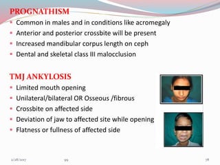 PROGNATHISM
 Common in males and in conditions like acromegaly
 Anterior and posterior crossbite will be present
 Increased mandibular corpus length on ceph
 Dental and skeletal class III malocclusion
TMJ ANKYLOSIS
 Limited mouth opening
 Unilateral/bilateral OR Osseous /fibrous
 Crossbite on affected side
 Deviation of jaw to affected site while opening
 Flatness or fullness of affected side
783/1/2017 99
 