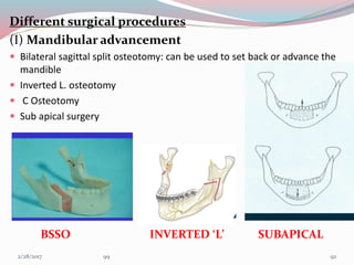 Different surgical procedures
(I) Mandibular advancement
 Bilateral sagittal split osteotomy: can be used to set back or advance the
mandible
 Inverted L. osteotomy
 C Osteotomy
 Sub apical surgery
BSSO INVERTED ‘L’ SUBAPICAL
923/1/2017 99
 