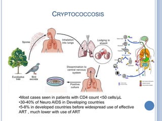 CRYPTOCOCCOSIS




•Most cases seen in patients with CD4 count <50 cells/µL
•30-40% of Neuro AIDS in Developing countries
•5-8% in developed countries before widespread use of effective
ART , much lower with use of ART
 