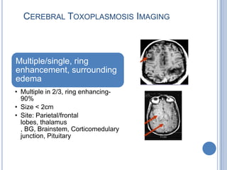 CEREBRAL TOXOPLASMOSIS IMAGING



Multiple/single, ring
enhancement, surrounding
edema
• Multiple in 2/3, ring enhancing-
  90%
• Size < 2cm
• Site: Parietal/frontal
  lobes, thalamus
  , BG, Brainstem, Corticomedulary
  junction, Pituitary
 