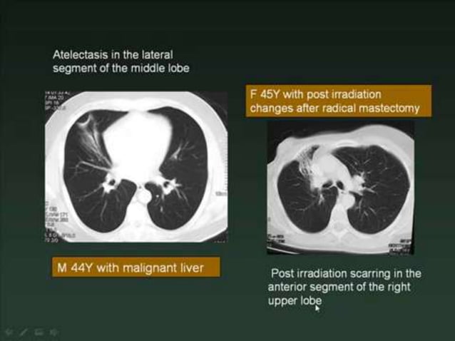 Normal chest ct | PPT