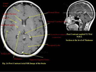 Occipital lobe ppt