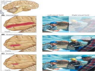 Occipital lobe ppt