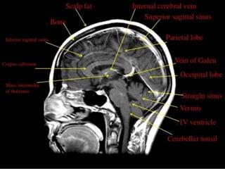 Occipital lobe ppt