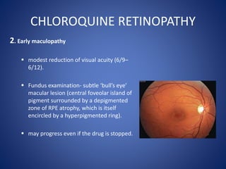 CHLOROQUINE RETINOPATHY
2. Early maculopathy
 modest reduction of visual acuity (6/9–
6/12).
 Fundus examination- subtle ‘bull’s eye’
macular lesion (central foveolar island of
pigment surrounded by a depigmented
zone of RPE atrophy, which is itself
encircled by a hyperpigmented ring).
 may progress even if the drug is stopped.
 