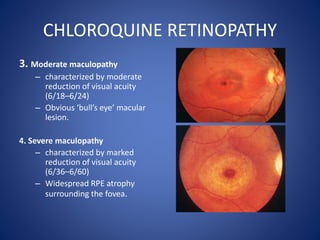 CHLOROQUINE RETINOPATHY
3. Moderate maculopathy
– characterized by moderate
reduction of visual acuity
(6/18–6/24)
– Obvious ‘bull’s eye’ macular
lesion.
4. Severe maculopathy
– characterized by marked
reduction of visual acuity
(6/36–6/60)
– Widespread RPE atrophy
surrounding the fovea.
 