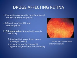 DRUGS AFFECTING RETINA
• Plaque-like pigmentation and focal loss of
the RPE and choriocapillaris.
• Diffuse loss of the RPE and
choriocapillaris.
2. Chlorpromazine: Normal daily dose is
75–300 mg.
Retinotoxicity ( larger doses over a
prolonged period)
It is characterized by nonspecific
pigmentary granularity and clumping.
diffuse atrophy of the RPE
and choriocapillaris
 