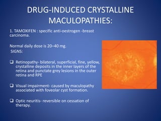 DRUG-INDUCED CRYSTALLINE
MACULOPATHIES:
1. TAMOXIFEN : specific anti-oestrogen -breast
carcinoma.
Normal daily dose is 20–40 mg.
SIGNS:
 Retinopathy- bilateral, superficial, fine, yellow,
crystalline deposits in the inner layers of the
retina and punctate grey lesions in the outer
retina and RPE
 Visual impairment- caused by maculopathy
associated with foveolar cyst formation.
 Optic neuritis- reversible on cessation of
therapy.
 