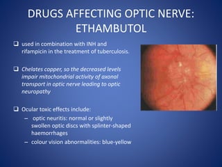 DRUGS AFFECTING OPTIC NERVE:
ETHAMBUTOL
 used in combination with INH and
rifampicin in the treatment of tuberculosis.
 Chelates copper, so the decreased levels
impair mitochondrial activity of axonal
transport in optic nerve leading to optic
neuropathy
 Ocular toxic effects include:
– optic neuritis: normal or slightly
swollen optic discs with splinter-shaped
haemorrhages
– colour vision abnormalities: blue-yellow
 