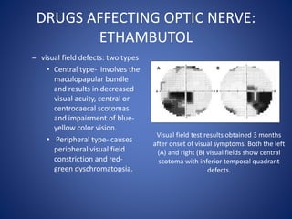 DRUGS AFFECTING OPTIC NERVE:
ETHAMBUTOL
– visual field defects: two types
• Central type- involves the
maculopapular bundle
and results in decreased
visual acuity, central or
centrocaecal scotomas
and impairment of blue-
yellow color vision.
• Peripheral type- causes
peripheral visual field
constriction and red-
green dyschromatopsia.
Visual field test results obtained 3 months
after onset of visual symptoms. Both the left
(A) and right (B) visual fields show central
scotoma with inferior temporal quadrant
defects.
 