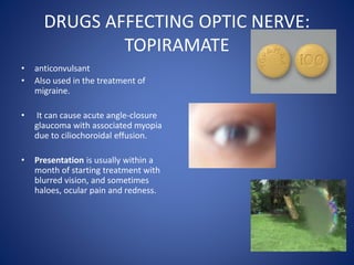 DRUGS AFFECTING OPTIC NERVE:
TOPIRAMATE
• anticonvulsant
• Also used in the treatment of
migraine.
• It can cause acute angle-closure
glaucoma with associated myopia
due to ciliochoroidal effusion.
• Presentation is usually within a
month of starting treatment with
blurred vision, and sometimes
haloes, ocular pain and redness.
 