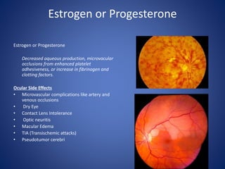 Estrogen or Progesterone
Estrogen or Progesterone
Decreased aqueous production, microvacular
occlusions from enhanced platelet
adhesiveness, or increase in fibrinogen and
clotting factors.
Ocular Side Effects
• Microvascular complications like artery and
venous occlusions
• Dry Eye
• Contact Lens Intolerance
• Optic neuritis
• Macular Edema
• TIA (Transischemic attacks)
• Pseudotumor cerebri
 