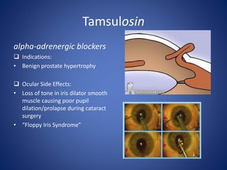 Tamsulosin
alpha-adrenergic blockers
 Indications:
• Benign prostate hypertrophy
 Ocular Side Effects:
• Loss of tone in iris dilator smooth
muscle causing poor pupil
dilation/prolapse during cataract
surgery
• “Floppy Iris Syndrome”
 