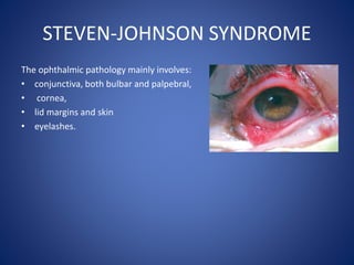 STEVEN-JOHNSON SYNDROME
The ophthalmic pathology mainly involves:
• conjunctiva, both bulbar and palpebral,
• cornea,
• lid margins and skin
• eyelashes.
 