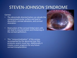 STEVEN-JOHNSON SYNDROME
Cornea:
• The abnormally directed lashes can abrade the
compromised ocular surface and lead to
discomfort, corneal abrasions, and corneal
ulceration.
• Destruction of the corneal limbal stem cells
can lead to vascularization and thickening of
the corneal epithelium.
• This “conjunctivalization” of the cornea,
accompanied by the abnormal tear film,
produces severe visual loss. Additionally, it
creates a poor prognosis for any future
corneal transplantation
 