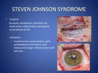 STEVEN JOHNSON SYNDROME
• Surgical:
Amniotic membrane: minimize the
destructive inflammation during the
acute phase of SJS
Indication-
– membranous conjunctivitis, early
symblepharon formation, and
intense lid margin inflammation with
lash loss
 