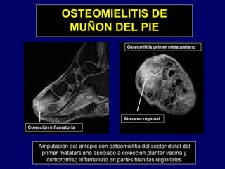 OSTEOMIELITIS DE
MUÑON DEL PIEMUÑON DEL PIE
Osteomilitis primer metatarsianoOsteomilitis primer metatarsiano
Absceso regional
A t ió d l t i t i liti d l t di t l d l
Colección inflamatoria
g
Amputación del antepie con osteomielitis del sector distal del
primer metatarsiano asociado a colección plantar vecina y
compromiso inflamatorio en partes blandas regionales
 