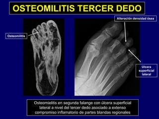 OSTEOMILITIS TERCER DEDO
Alteración densidad ósea
Osteomilitis
UlceraU ce a
superficial
lateral
O t i liti d f l úl fi i lOsteomielitis en segunda falange con úlcera superficial
lateral a nivel del tercer dedo asociado a extenso
compromiso inflamatorio de partes blandas regionales
 