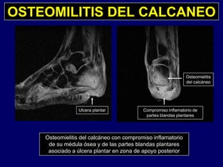 OSTEOMILITIS DEL CALCANEO
Osteomielitis
del calcáneo
Ulcera plantar Compromiso inflamatorio de
partes blandas plantares
Osteomielitis del calcáneo con compromiso inflamatorio
d éd l ó d l t bl d l tde su médula ósea y de las partes blandas plantares
asociado a úlcera plantar en zona de apoyo posterior
 