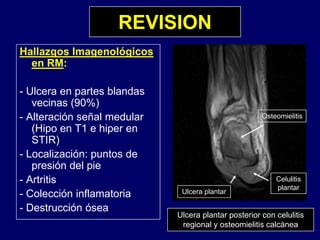 REVISION
Hallazgos Imagenológicos
en RM:
- Ulcera en partes blandas
vecinas (90%)vecinas (90%)
- Alteración señal medular
(Hipo en T1 e hiper en
STIR)
Osteomielitis
STIR)
- Localización: puntos de
presión del pie
- Artritis
- Colección inflamatoria
Destr cción ósea
Ulcera plantar
Celulitis
plantar
Ulcera plantar posterior con celulitis
regional y osteomielitis calcánea
- Destrucción ósea
 