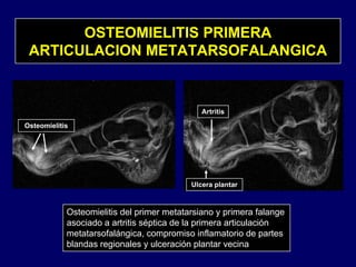 OSTEOMIELITIS PRIMERA
ARTICULACION METATARSOFALANGICA
Artritis
Osteomielitis
Ulcera plantar
Osteomielitis del primer metatarsiano y primera falange
asociado a artritis séptica de la primera articulación
metatarsofalángica, compromiso inflamatorio de partes
blandas regionales y ulceración plantar vecina
 