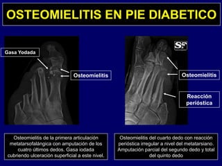 OSTEOMIELITIS EN PIE DIABETICO
Gasa Yodada
Osteomielitis Osteomielitis
R ióReacción
perióstica
Osteomielitis de la primera articulación
t t f lá i t ió d l
Osteomielitis del cuarto dedo con reacción
ió ti i l i l d l t t imetatarsofalángica con amputación de los
cuatro últimos dedos. Gasa iodada
cubriendo ulceración superficial a este nivel.
perióstica irregular a nivel del metatarsiano.
Amputación parcial del segundo dedo y total
del quinto dedo
 