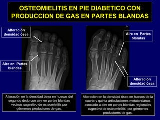 OSTEOMIELITIS EN PIE DIABETICO CON
PRODUCCION DE GAS EN PARTES BLANDASPRODUCCION DE GAS EN PARTES BLANDAS
Aire en Partes
Alteración
densidad ósea Aire en Partes
blandas
densidad ósea
Aire en Partes
blandas
Alteración
densidad ósea
blandas
Alteración en la densidad ósea en huesos de la
cuarta y quinta articulaciones metatarsianas
Alteración en la densidad ósea en huesos del
segundo dedo con aire en partes blandas
asociado a aire en partes blandas regionales
sugestivo de osteomielitis por gérmenes
productores de gas.
vecinas sugestivo de osteomielitis por
gérmenes productores de gas.
 