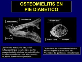 OSTEOMIELITIS EN
PIE DIABETICOPIE DIABETICO
Osteomielitis
Tenosinovitis
Osteomielitis
Ulcera
AbscesoFístula a piel
Osteomielitis de la quinta articulación
metatarsofalángica con ulceración plantar,
compromiso inflamatorio de las partes blandas
Osteomielitis del cuarto metatarsiano con
absceso regional que fistulizó a piel.
Amputación del quinto dedo y metatarsiano
dorsales regionales asociado a tenosinovitis
del tendón extensor correspondiente.
Amputación del quinto dedo y metatarsiano.
 