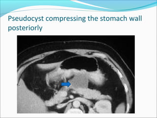 Pseudocyst compressing the stomach wall
posteriorly
 