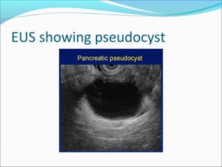 EUS showing pseudocyst
 