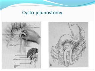 Cysto-jejunostomy
 