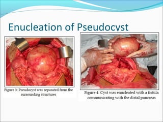 Enucleation of Pseudocyst
 