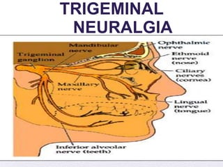 4/5/2014
TRIGEMINAL
NEURALGIA
 