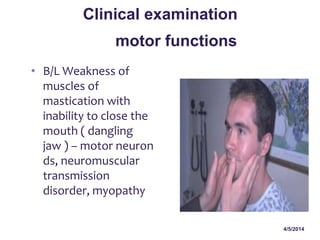 4/5/2014
• B/L Weakness of
muscles of
mastication with
inability to close the
mouth ( dangling
jaw ) – motor neuron
ds, neuromuscular
transmission
disorder, myopathy
Clinical examination
motor functions
 