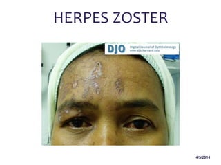 4/5/2014
HERPES ZOSTER
 