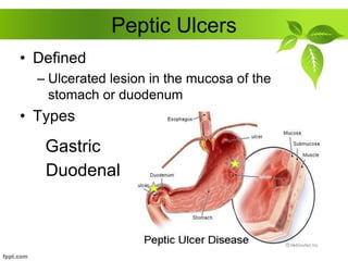 Peptic Ulcers
• Defined
– Ulcerated lesion in the mucosa of the
stomach or duodenum
• Types
Gastric
Duodenal
 