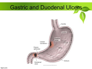 Gastric and Duodenal Ulcers
 