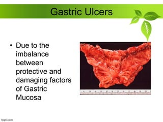 Gastric Ulcers
• Due to the
imbalance
between
protective and
damaging factors
of Gastric
Mucosa
 