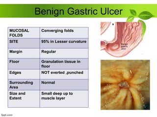 Benign Gastric Ulcer
MUCOSAL
FOLDS
Converging folds
SITE 95% in Lesser curvature
Margin Regular
Floor Granulation tissue in
floor
Edges NOT everted ,punched
Surrounding
Area
Normal
Size and
Extent
Small deep up to
muscle layer
 