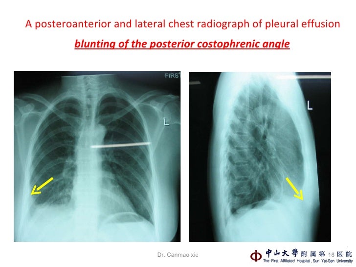 Pleural Effusions