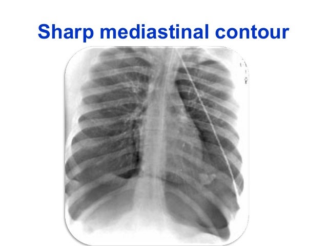 Pneumothorax